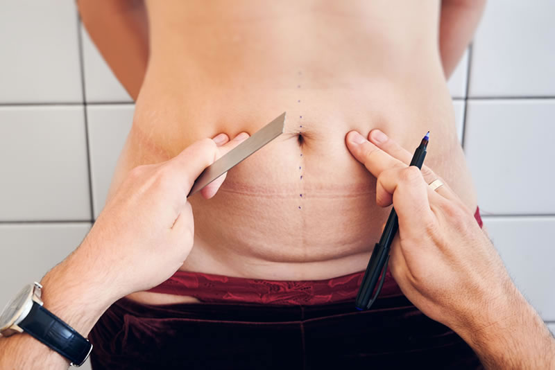 Cirugia de Abdomen
