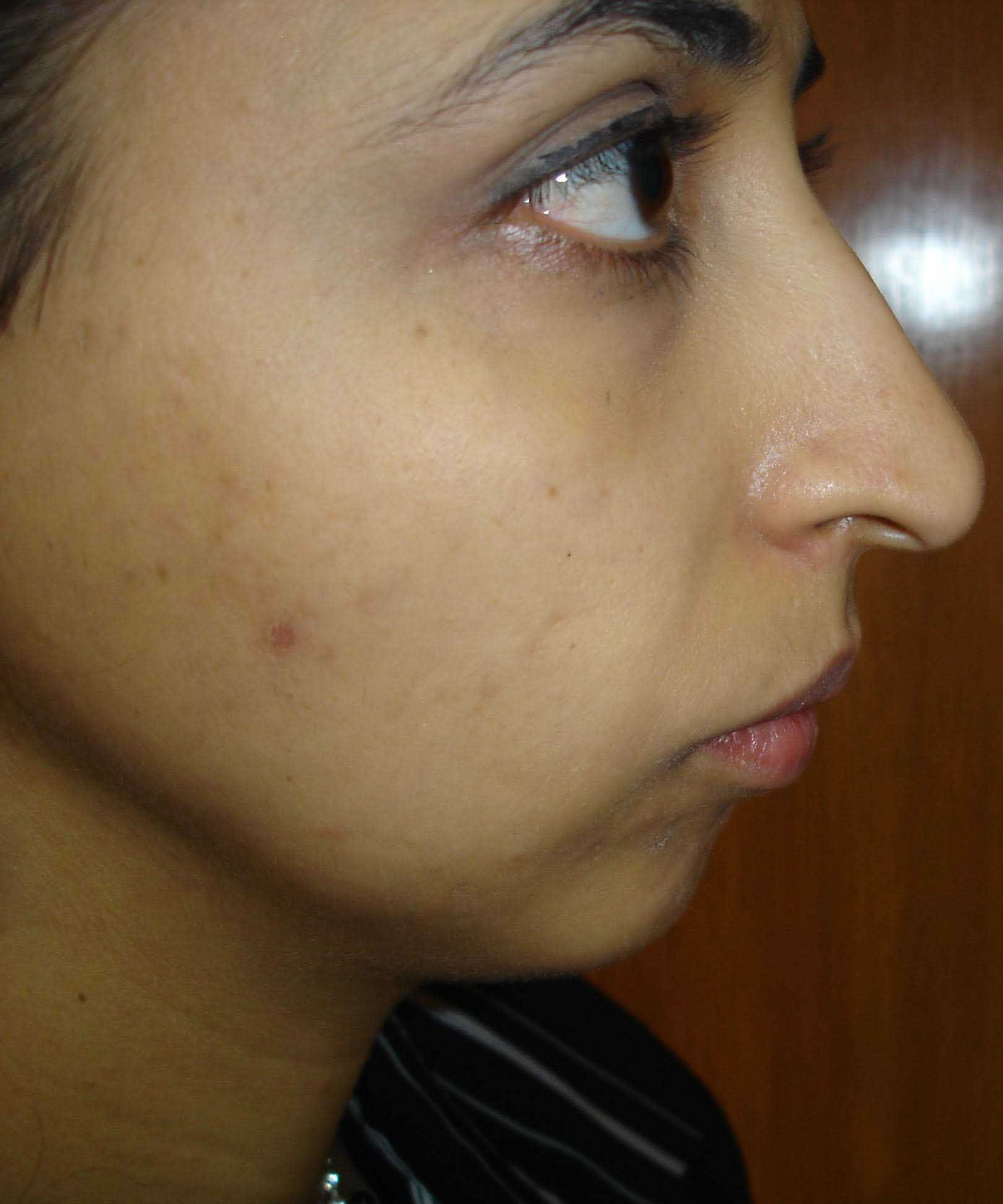 Before Chin Surgery