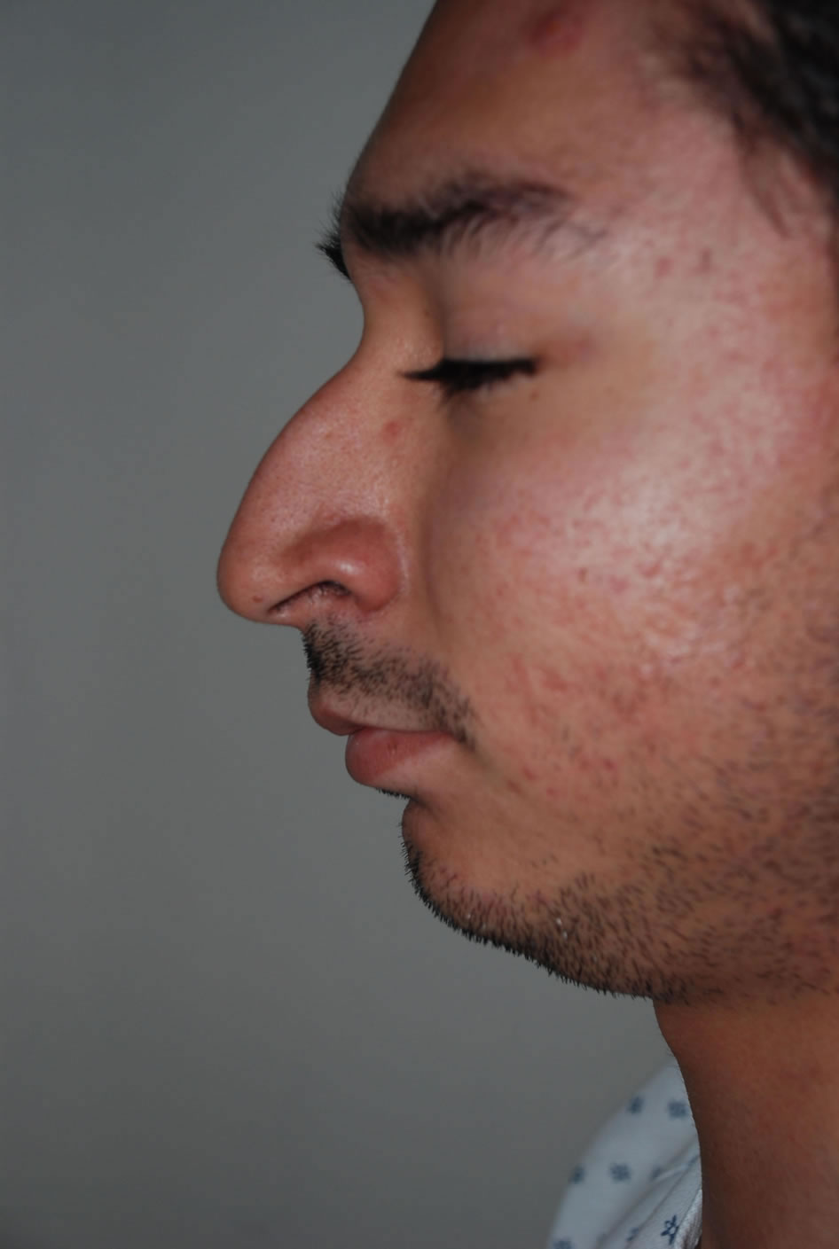 Before Nose Surgery