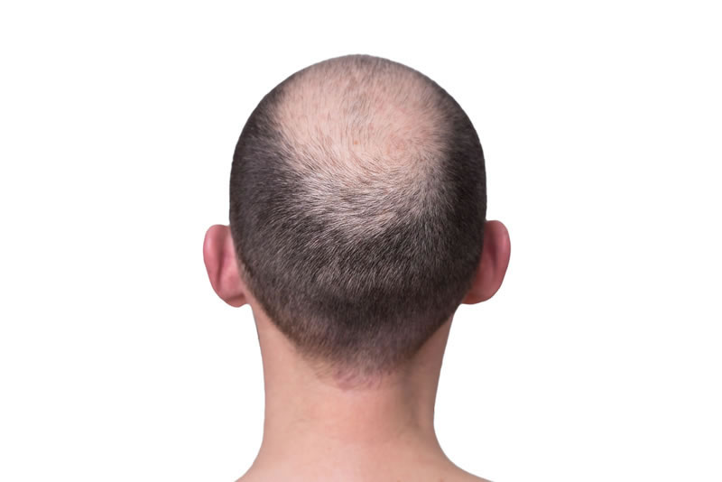 Hair Implants
