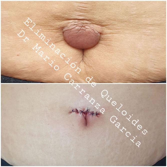 Cirugia de Cicatrices