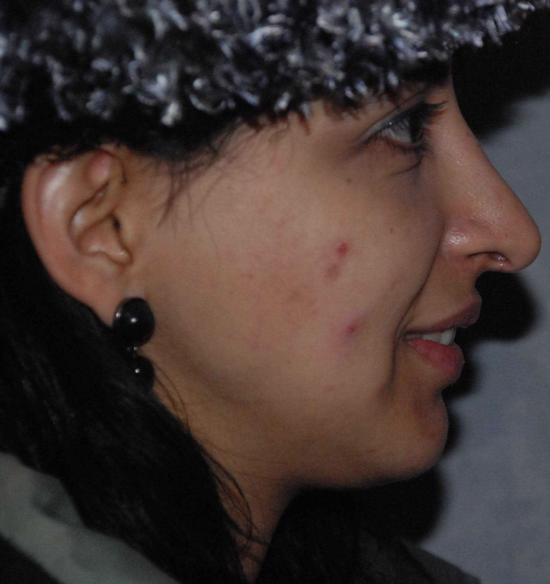 After Chin Surgery