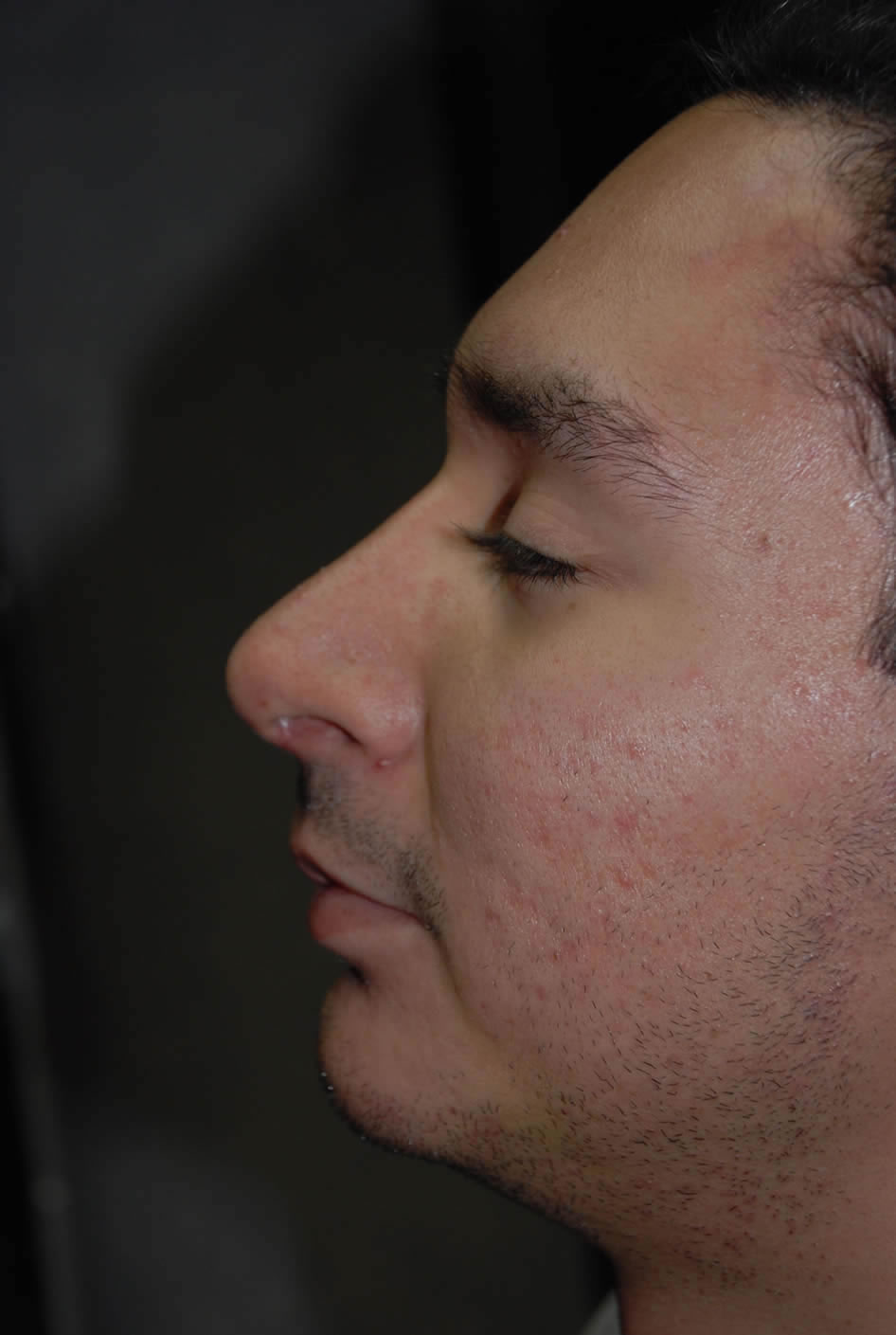 After Nose Surgery
