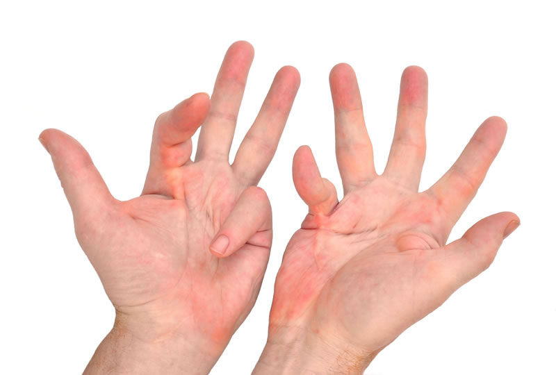Enfermedad de Dupuytren