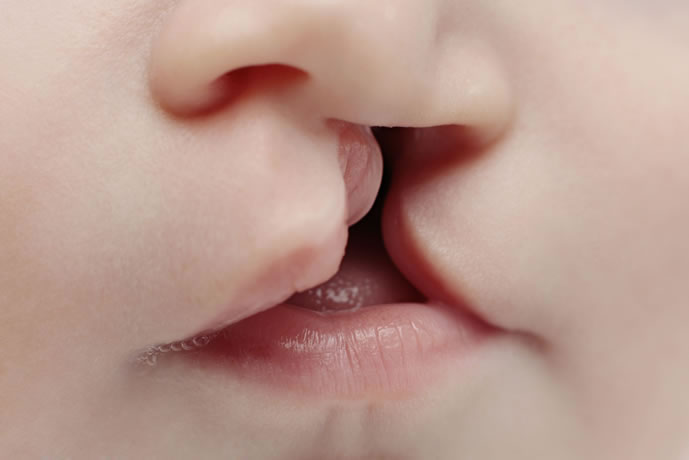 Hare Lip And Clef Palate Surgery