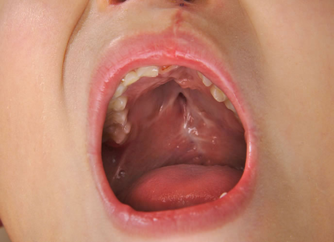 Hare Lip And Clef Palate Surgery