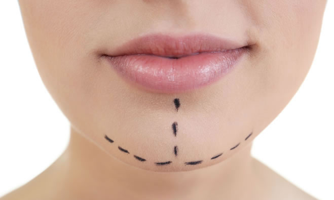 Chin Surgery