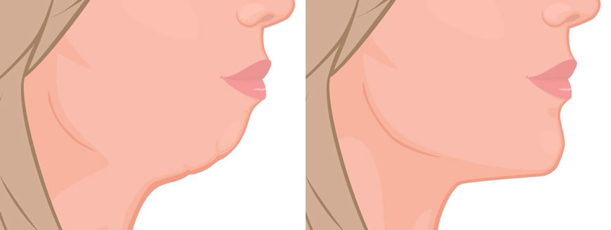 Chin Surgery