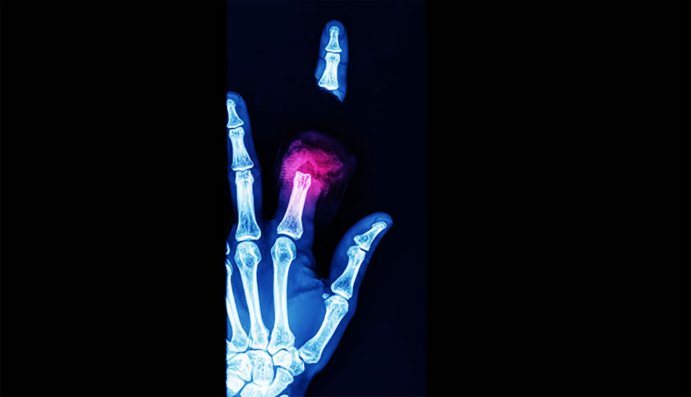 Reconstrucción de Mano